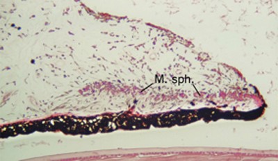 Histopatología Iris