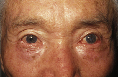 Entropion Cicatricial, figura 8